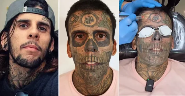 Imagem ilustrativa da notícia Evangélico, "homem mais tatuado do Brasil" remove tatuagens