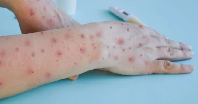 Imagem ilustrativa da notícia Casos de Mpox no BR em 2024 superam o número total de 2023