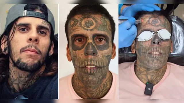 Imagem ilustrativa da notícia Evangélico, "homem mais tatuado do Brasil" remove tatuagens