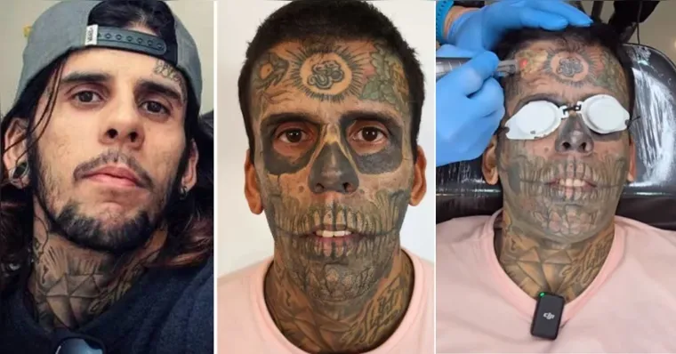 Imagem ilustrativa da notícia Evangélico, "homem mais tatuado do Brasil" remove tatuagens