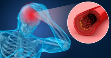 Descubra os fatores de risco do AVC e proteja-se!