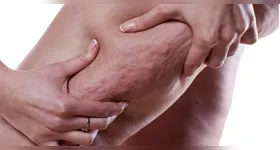 A celulite deixa pequenos furinhos pelo corpo. Veja como eliminá-la!