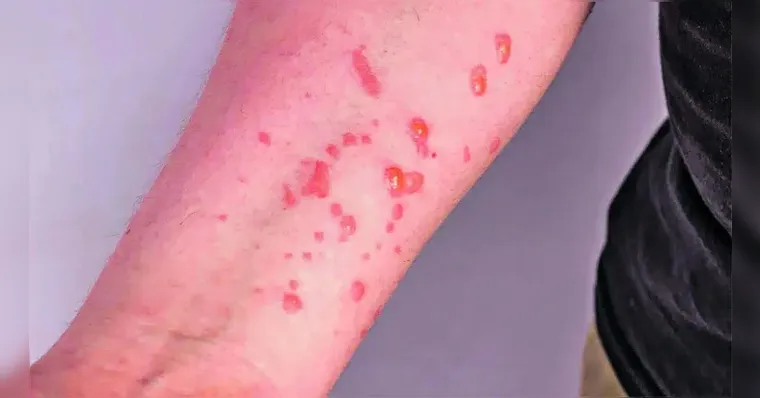 Imagem ilustrativa da notícia Brasil contabiliza 1,5 mil casos de mpox em 2024
