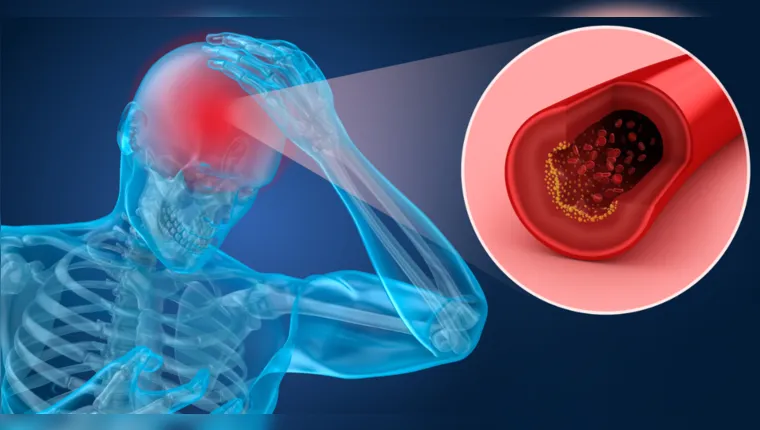 Imagem ilustrativa da notícia AVC está entre as principais causas de mortes no Brasil