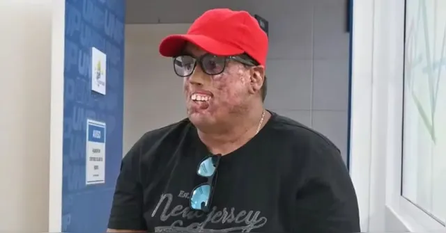 Imagem ilustrativa da notícia Brasileiro com doença rara passa por 230 cirurgias no rosto