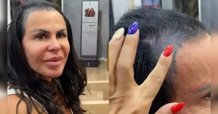Imagem ilustrativa da notícia Com alopecia, Gretchen grava vídeo sem mega hair
