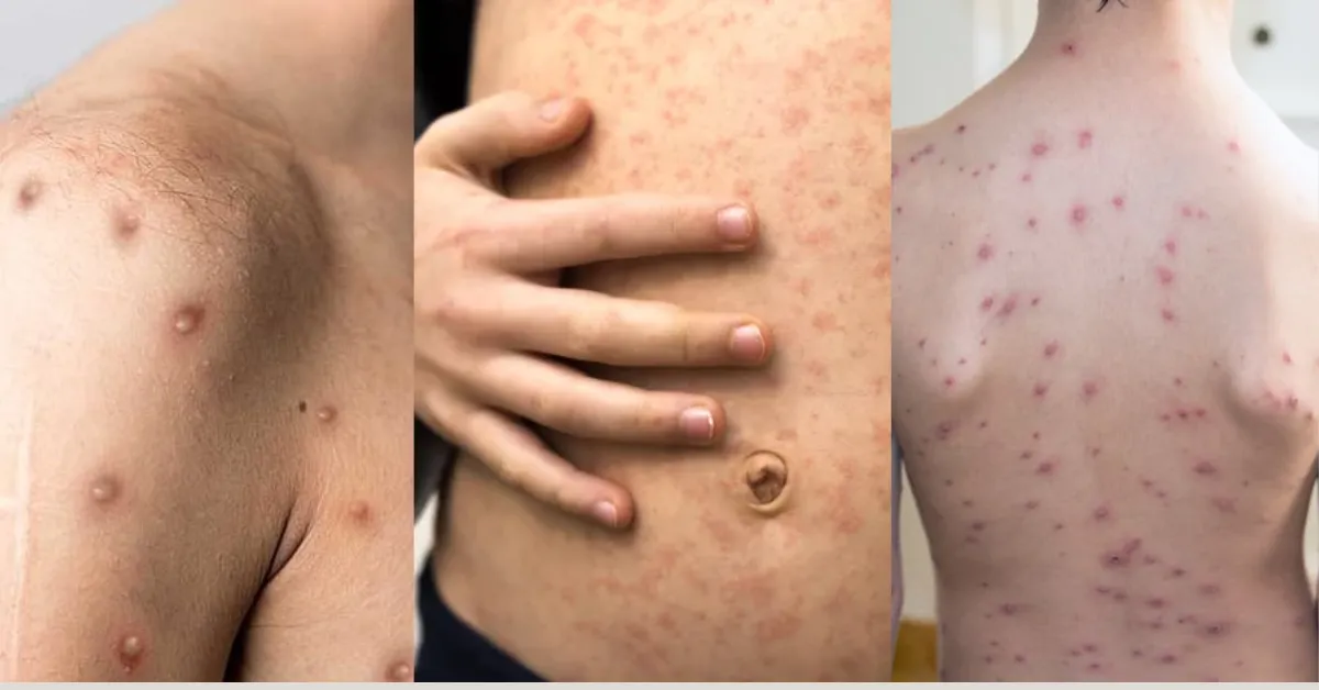 Mpox, sarampo e catapora
