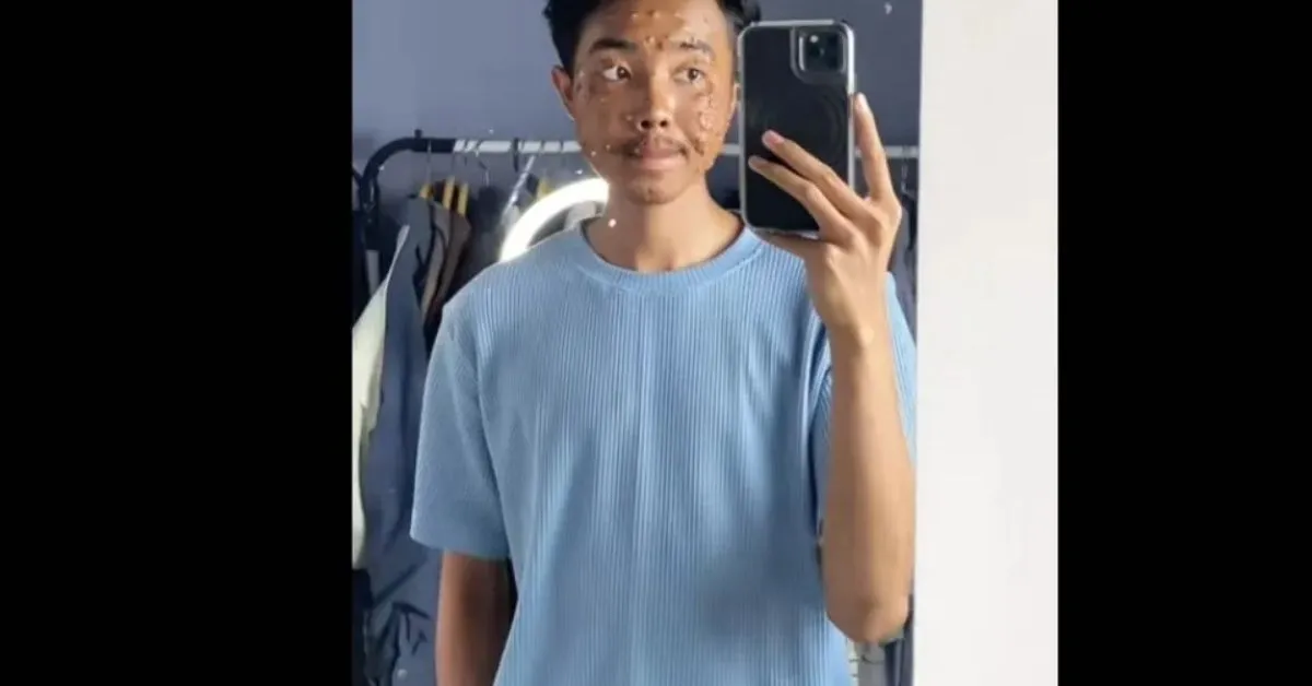 Jovem contrai infecção após usar roupa de brechó e compartilha situação na internet.