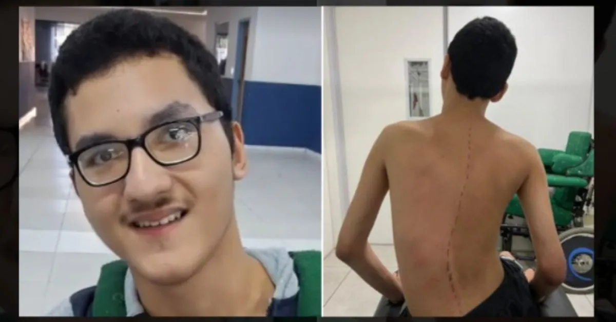 Com paralisia cerebral e escoliose grave, Samuel Cecim precisa de ajuda para cirurgia em SP.