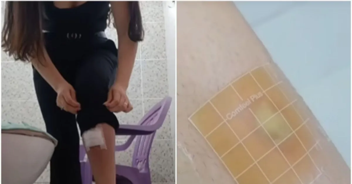 A influenciadora precisou usar sete placas de hidrocolóide, por cerca de três semanas, até fechar a ferida por completo.