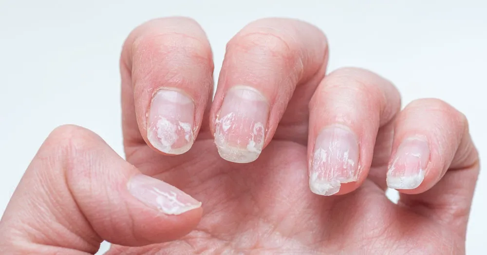 De início, é importante notar alterações de superfície das unhas, cujas principais características são estarem quebradiças, ter a superfície rugosa e descamação visível.