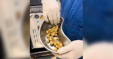 Nas imagens, Dr. Thales aparece ao lado do paciente, que revela consumir de 2 a 3 litros de refrigerante por dia.
