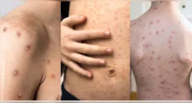 Mpox, sarampo e catapora