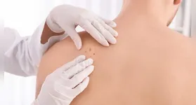 Manchas pelo corpo pode indicar sinal de câncer