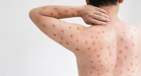 A mpox é uma doença zoonótica causada pelo vírus mpox (MPXV), do gênero Orthopoxvirus e da família Poxviridae.