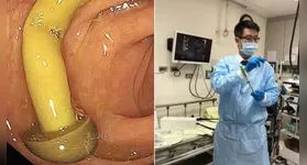 Cogumelo alojado no intestino do paciente
