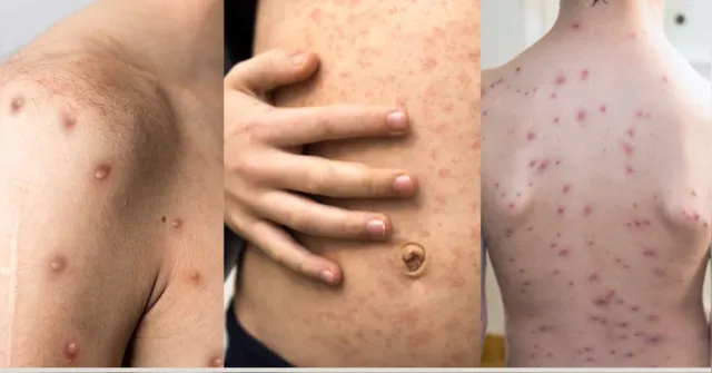 Imagem ilustrativa da notícia Entenda a diferença entre mpox, sarampo e catapora