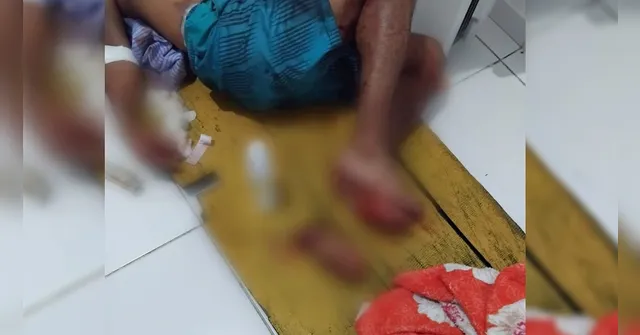 Imagem ilustrativa da notícia Homem tem a mão amputada durante briga no Marajó