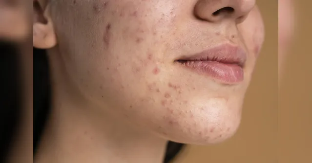 Imagem ilustrativa da notícia Quais alimentos podem piorar a acne? Veja os mais prejudiciais