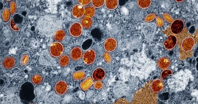 Imagem ilustrativa da notícia Sesma e Sespa reforçam que não há surto de Mpox no Pará
