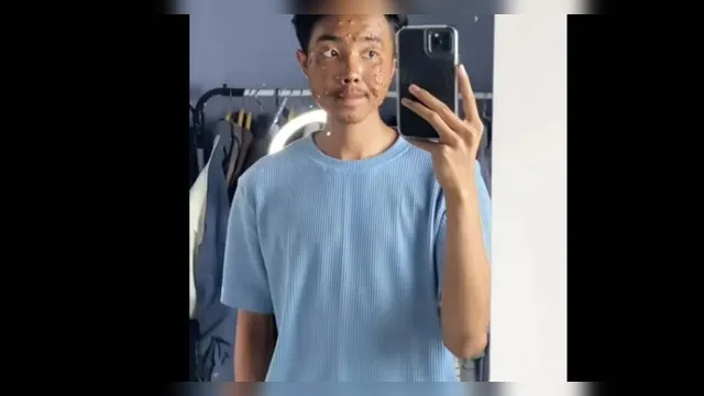 Imagem ilustrativa da notícia Jovem contrai infecção viral após usar roupa de brechó
