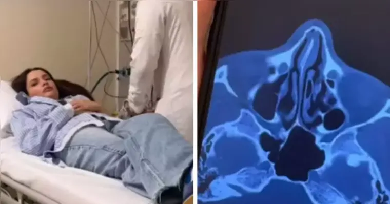Imagem ilustrativa da notícia Juliette fratura o nariz após acidente doméstico: "Meio torto"