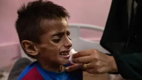 Criança desnutrida em Gaza