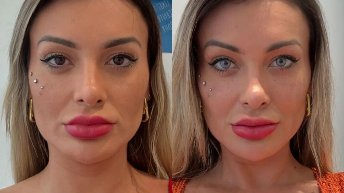 Recentemente, as influenciadoras Andressa Urach, 37, e Maya Massafera, 44, chamaram a atenção ao realizar cirurgia para mudar a cor dos olhos.