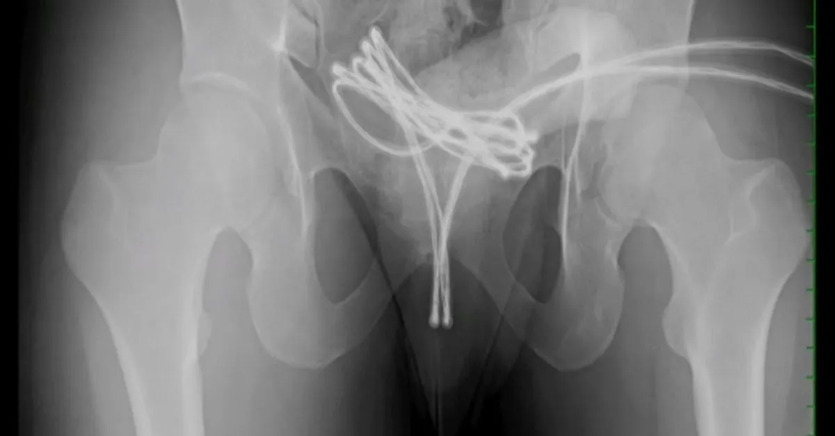 O cabo subiu até a bexiga do homem que precisou passar por uma cirurgia.