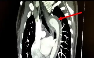 Durante o orgasmo, a paciente relatou uma dor torácica súbita e intensa, que se irradiava para as costas, acompanhada de falta de ar e náuseas.