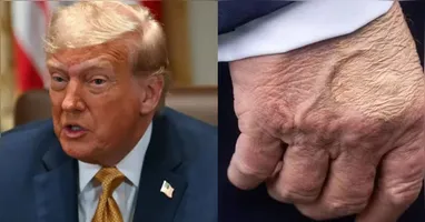 Insuficiência venosa crônica que afeta Trump: conheça as causas, sintomas e cuidados.
