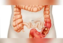 Imagem ilustrativa da notícia Oncologista alerta sobre sintomas do Câncer Colorretal