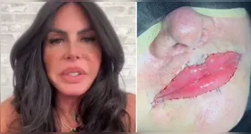 A decisão de Gretchen de retirar o produto reacende o debate sobre os riscos de procedimentos estéticos