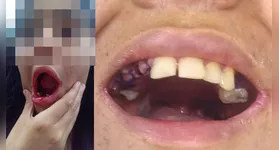 A jovem foi internada para um procedimento de restauração dentária, mas teve 17 dentes extraídos sem autorização da família.