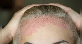 As manifestações mais visíveis da psoríase são lesões avermelhadas com escamas esbranquiçadas.