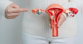 Os miomas uterinos, também conhecidos como leiomiomas ou fibromas, são formados a partir do crescimento anormal de células musculares lisas no útero.