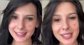 De cara limpa, Ana Castela surge com espinhas no rosto e fala com sinceridade sobre tratamento e mudanças de hábitos