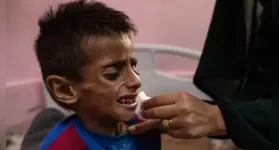 Criança desnutrida em Gaza