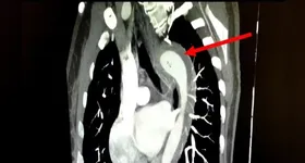 Durante o orgasmo, a paciente relatou uma dor torácica súbita e intensa, que se irradiava para as costas, acompanhada de falta de ar e náuseas.