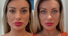 Recentemente, as influenciadoras Andressa Urach, 37, e Maya Massafera, 44, chamaram a atenção ao realizar cirurgia para mudar a cor dos olhos.