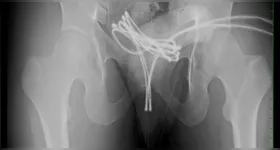 O cabo subiu até a bexiga do homem que precisou passar por uma cirurgia.