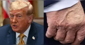 Insuficiência venosa crônica que afeta Trump: conheça as causas, sintomas e cuidados.
