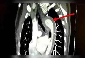 Durante o orgasmo, a paciente relatou uma dor torácica súbita e intensa, que se irradiava para as costas, acompanhada de falta de ar e náuseas.