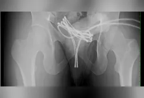 O cabo subiu até a bexiga do homem que precisou passar por uma cirurgia.