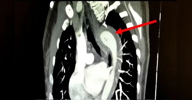Imagem ilustrativa da notícia Mulher rompe aorta durante relação sexual com o marido