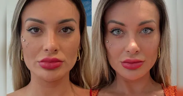 Imagem ilustrativa da notícia Quais são os riscos da cirurgia que muda a cor dos olhos?