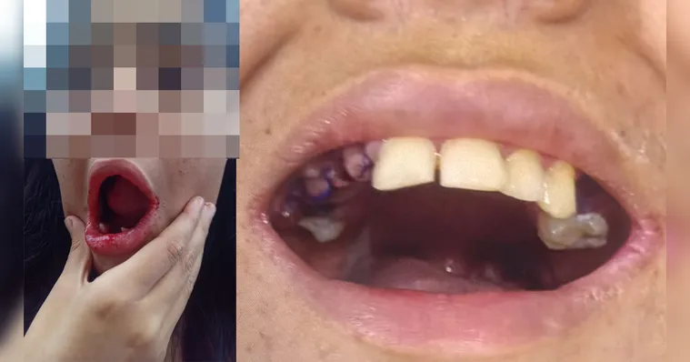 Imagem ilustrativa da notícia Helder afasta médico que extraiu 17 dentes de jovem autista