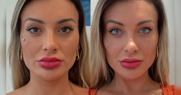 Imagem ilustrativa da notícia Quais são os riscos da cirurgia que muda a cor dos olhos?