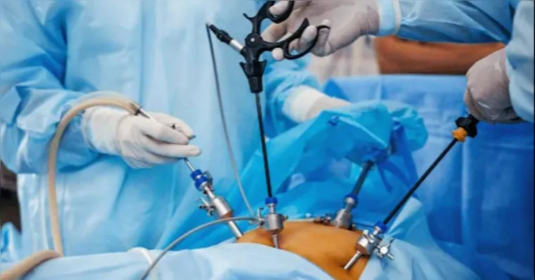 Imagem ilustrativa da notícia Saiba as novas regras para fazer cirurgia bariátrica no Brasil