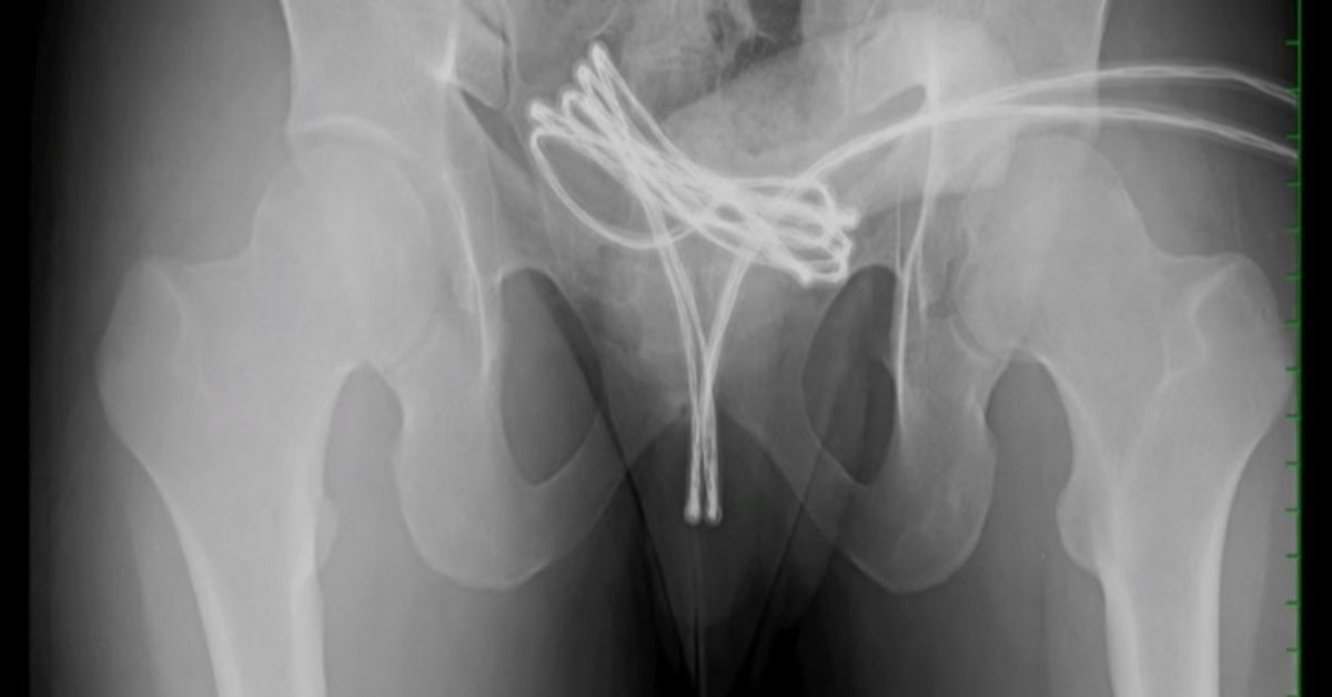 O cabo subiu até a bexiga do homem que precisou passar por uma cirurgia.